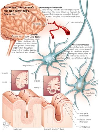 Alzheimer