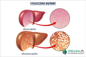 Stłuszczenie wątroby