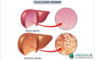 Stłuszczenie wątroby