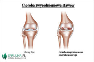 Choroba zwyrodnieniowa stawów