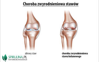 Choroba zwyrodnieniowa stawów