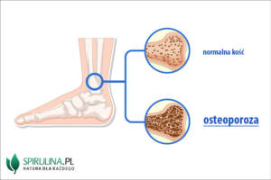 Osteoporoza