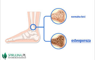 Osteoporoza