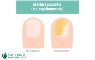 Grzybica paznokci