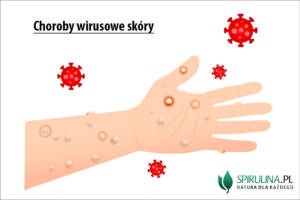 Choroby wirusowe skóry