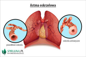 Astma oskrzelowa