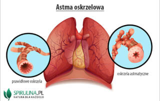 Astma oskrzelowa