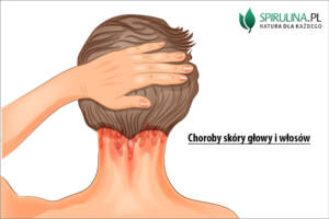 Choroby skóry głowy i włosów