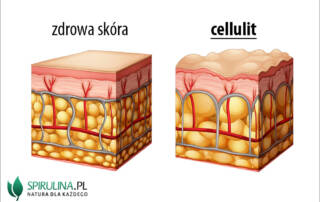 Cellulit