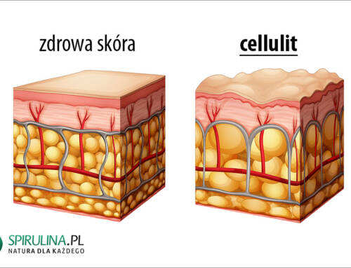 Cellulit