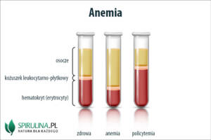 Anenmia