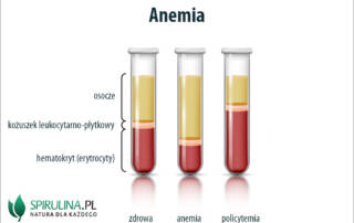Anenmia