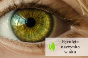 Pęknięte naczynko w oku - przyczyny i leczenie