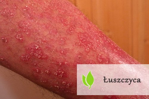 Łuszczyca – przyczyny, przebieg, leczenie Łuszczyca - przyczyny, przebieg, leczenie