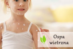 Ospa wietrzna