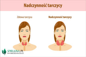 Nadczynność tarczycy