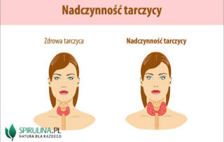 Nadczynność tarczycy