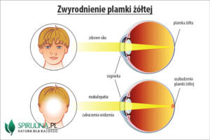 Zwyrodnienie plamki żółtej