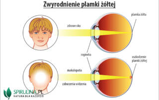 Zwyrodnienie plamki żółtej