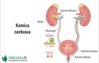 Kamica nerkowa