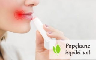 Popękane kąciki ust