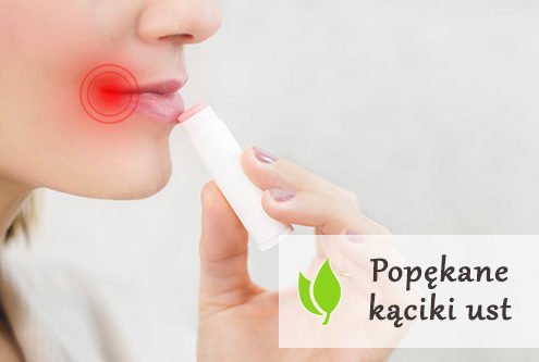 Popękane kąciki ust
