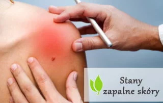 Stany zapalne skóry