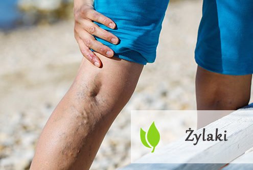 Żylaki