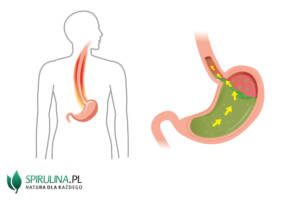 Co jeść przy refluksie?