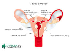 Kiedy mięśniaki są niebezpieczne?