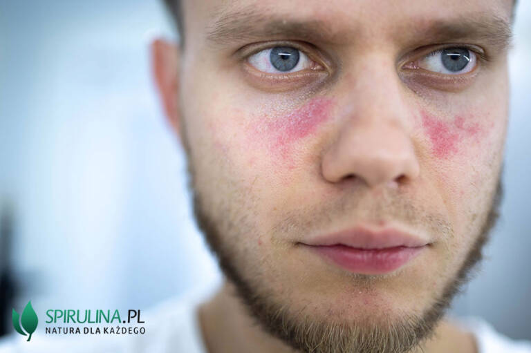 Toczeń co to za choroba? algi Spirulina i Chlorella