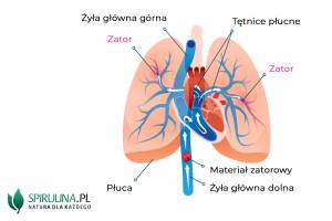 Czy zatorowość płucna jest groźna?