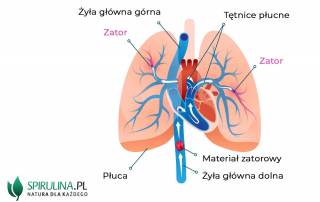 Czy zatorowość płucna jest groźna?