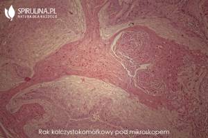 Choroba Bowena - rak kolczystokomórkowy pod mikroskopem