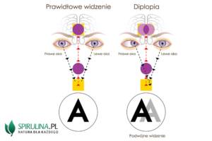 Podwójne widzenie (diplopia)