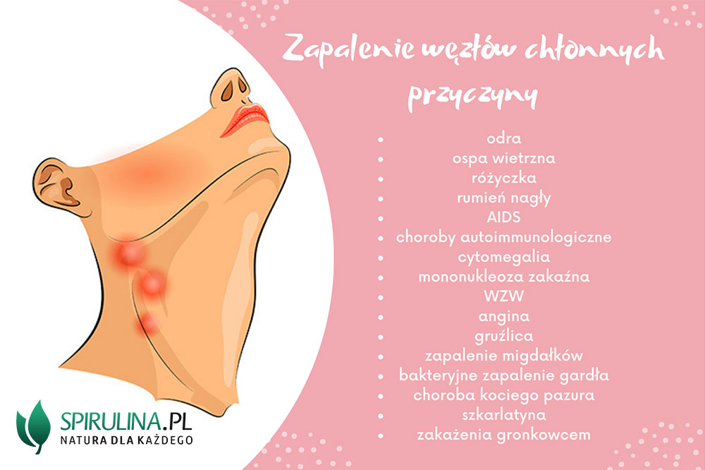 Zapalenie węzłów chłonnych przyczyny