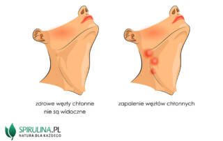 Zapalenie węzłów chłonnych
