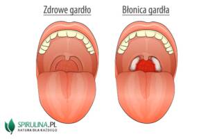 Błonica gardła