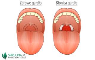 Błonica gardła