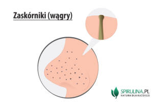 Zaskórniki (wągry)