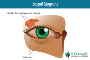 Zespół Sjogrena