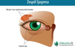 Zespół Sjogrena