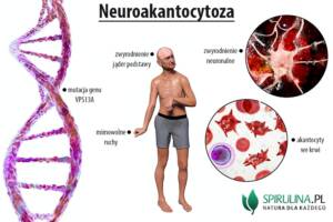 Neuroakantocytoza