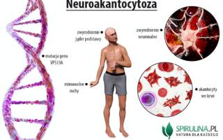 Neuroakantocytoza