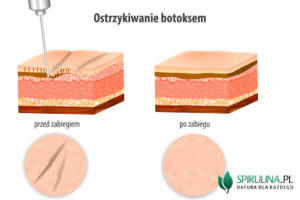 Botoks (toksyna botulinowa)