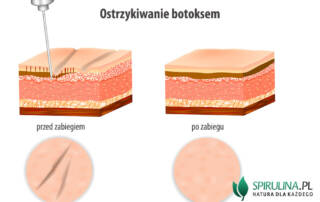 Botoks (toksyna botulinowa)