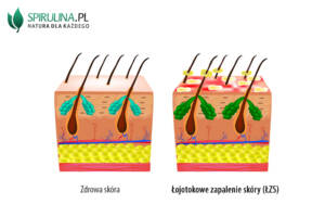 Łojotokowe zapalenie skóry (ŁZS)