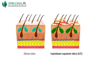 Łojotokowe zapalenie skóry (ŁZS)