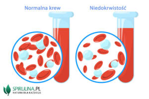 Niedokrwistość