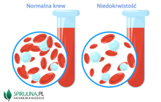 Niedokrwistość